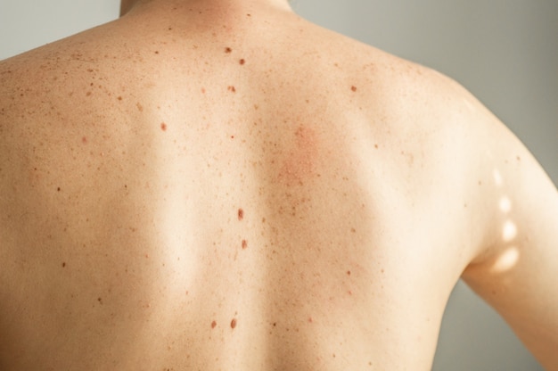 Close Up Detail De La Peau Nue Sur Le Dos D'un Homme Avec Des Grains De Beauté Et Des Taches De Rousseur. Vérification Des Grains De Beauté Bénins