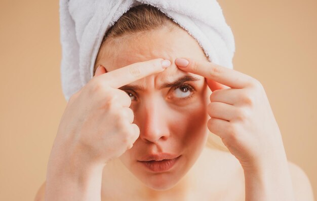 Close up woman serrant des boutons sur son visage des taches d'acné sur la peau jeune femme spot cicatrice acné f