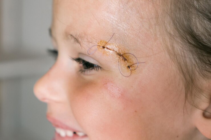Closeup smiling patient kid girl face avec joint de points de suture sur zéro de dissection des sourcils regarder loin Nettoyer cicatrice plaie