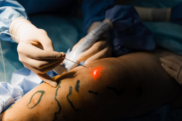 Photo coagulation laser endoveineuse pour le traitement des varices le chirurgien vasculaire opère à l'aide de la fibre optique laser rouge evlt pour le traitement de la thrombophlébite thrombose des jambes en salle d'opération