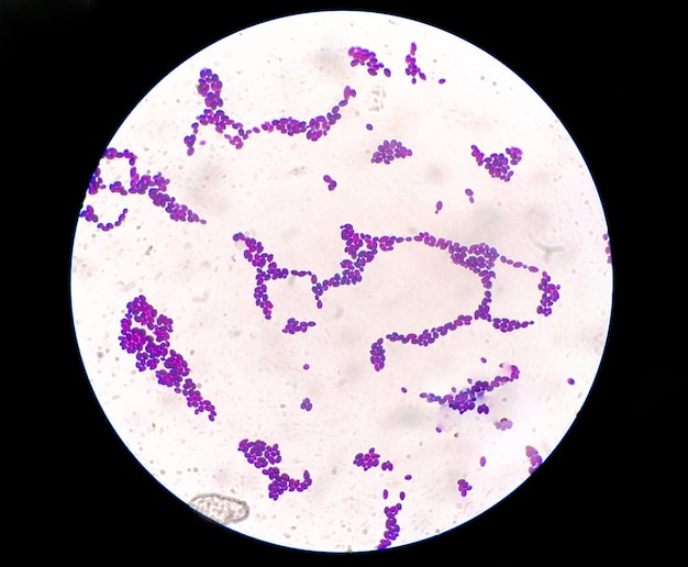 Coloration de Gram sous vue microscopique montrant une colonie de Candida ou Candida albicans