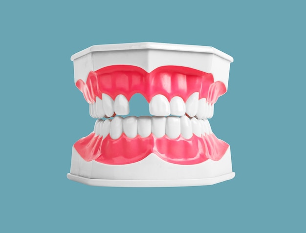 Concept de perte de dents Dents manquantes dans le modèle de mâchoire sur fond Problèmes de dentisterie Absence d'écart