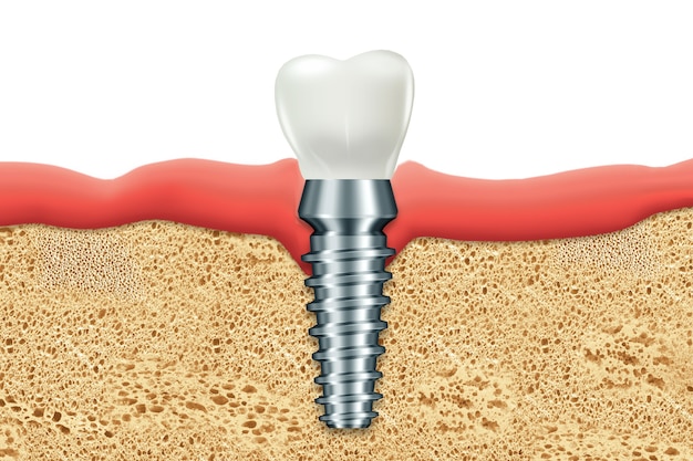 Concept de remplacement des dents, prothèses dentaires