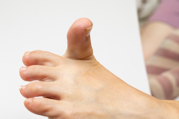 Photo concept de risque hallux valgus pied féminin avec gros orteil pointant vers le haut