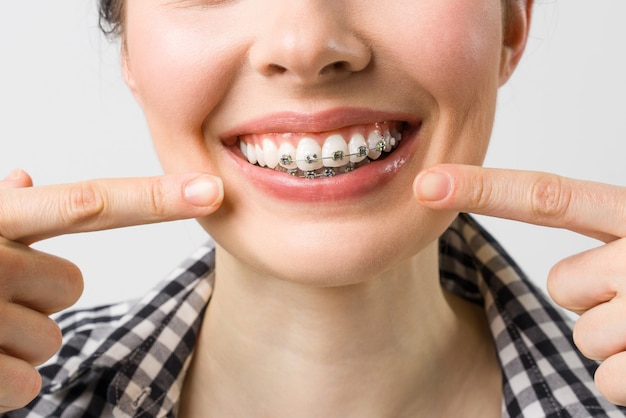 Concept de soins dentaires de traitement orthodontique belle femme sourire sain gros plan en céramique et