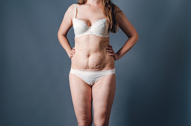 Corps féminin en lingerie blanche après l'accouchement des verrues sur la peau de la femme dépression post-partum