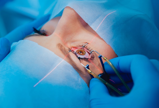 Correction de la vue au laser. Un patient et une équipe de chirurgiens en salle d'opération lors d'une chirurgie ophtalmique. Spéculum de paupière. Traitement Lasik.