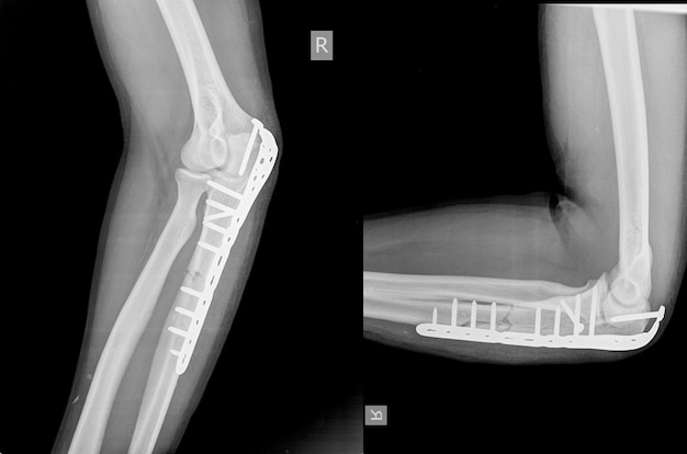 Coude Une fracture olécranienne peut être maintenue avec une plaque et des vis.