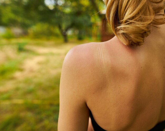 Coup de soleil sur l'épaule et le dos d'une fille de race blanche se détendre en été