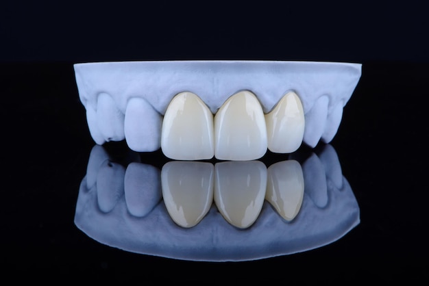 Couronnes unitaires naturellement dentaires de haute qualité en zirconium pour la fixation aux dents frontales de