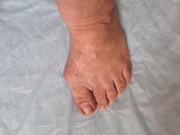 Photo déformations valgus du pied plat problème et maladie orthopédiques