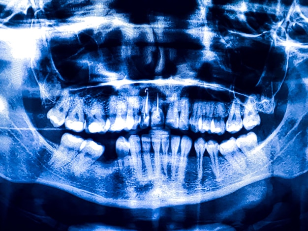 Dent dentaire panoramique Xray Radiographie pour le concept de recherche sur les structures dentaires