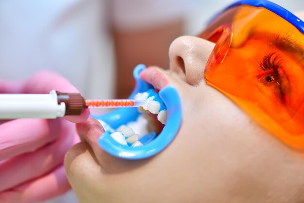 Le dentiste applique un gel blanchissant sur les dents du patient