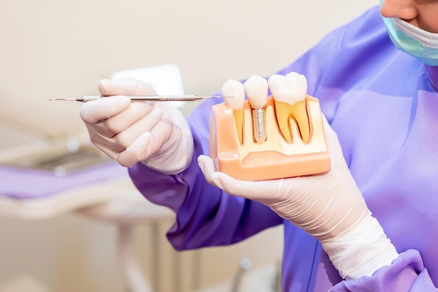 Dentiste avec implant dentaire fausses dents. Concept de dentisterie et de soins de santé à la clinique dentaire.