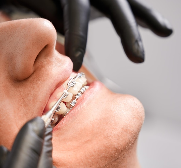 Dentiste plaçant des élastiques sur les accolades des patients masculins