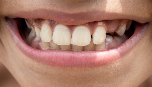 Dents d'enfant vue rapprochée avec une expression joyeuse