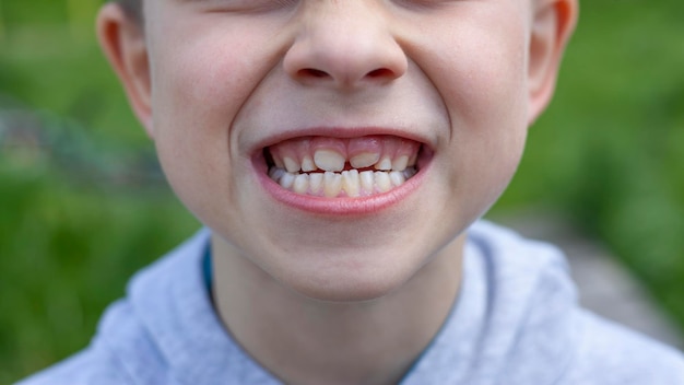 Dents d'enfants La molaire pousse dans la deuxième rangée Anomalies de la croissance des dents