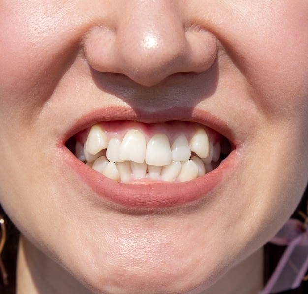 Dents femelles courbées, avant d'installer un appareil dentaire Close - up de dents avant traitement par un orthodontiste