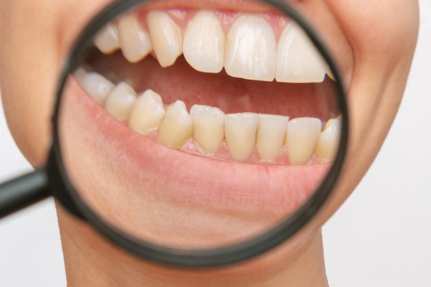 Les dents de la jeune femme avec tartre et plaque jaune agrandies dans une loupe