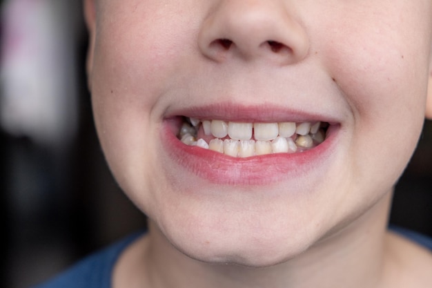 Les dents tordues de Childs jeune homme montrant des dents tordues en croissance