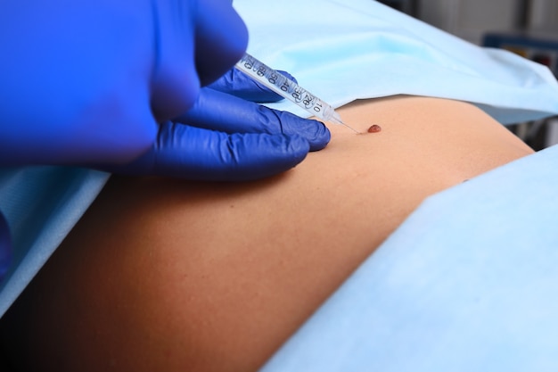Le dermatologue cosmétologue chirurgien supprime une taupe ou un naevus sur l'estomac d'une femme
