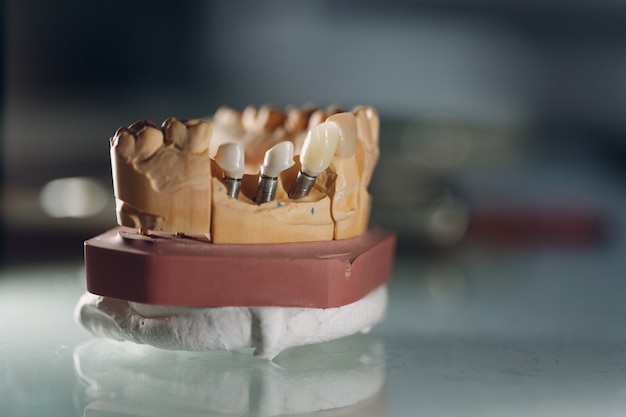 Disposition dentaire de la mâchoire humaine avec des dents et des implants.