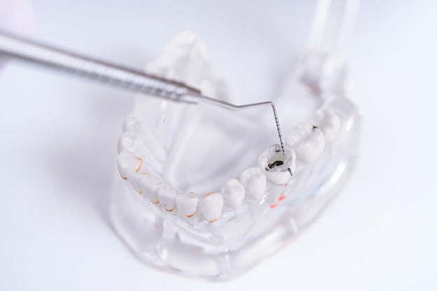 Docteur orthodontiste montre l'instrument sur les caries dans les dents