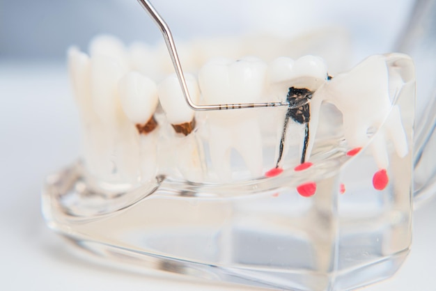 Docteur orthodontiste montre l'instrument sur les caries dans les dents