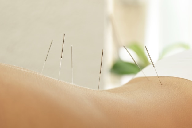 Photo dos de femme avec des aiguilles en acier pendant la procédure de thérapie d'acupuncture