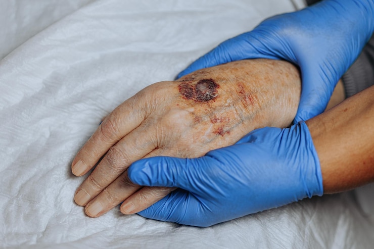 Photo un ecchymose sur la main d'une personne âgée connue sous le nom de purpure sénile causée par la fragilité de la peau et des vaisseaux sanguins dans la vieillesse soins des personnes âgées