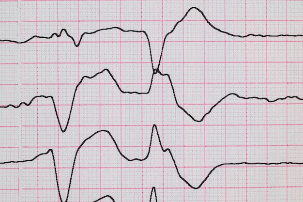 ECG avec perturbation du rythme et gros plan de l'extrasystole ventriculaire