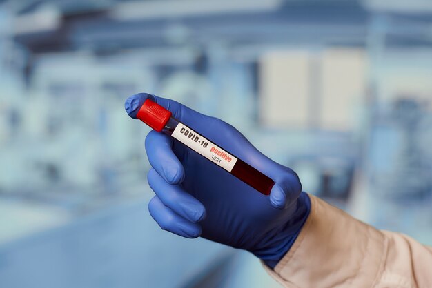 Un échantillon de sang de coronavirus positif (COVID-19) en laboratoire.