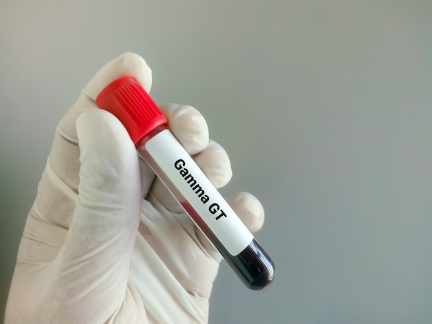 Photo Échantillon de sang pour le diagnostic de test gamma gt ou ggt pour la fonction hépatique