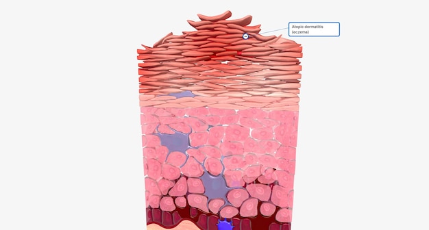 Eczéma au niveau cellulaire