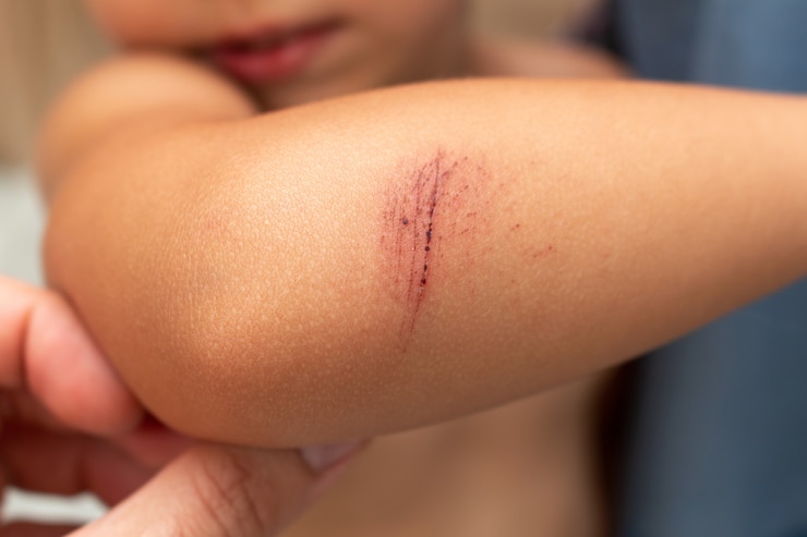 Photo égratignure, blessure, abrasion sur le coude des enfants