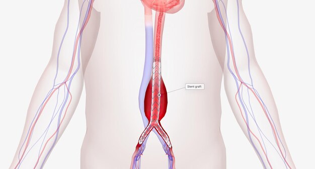 Une endoprothèse est un treillis métallique fin recouvert d'un tissu en forme de tube