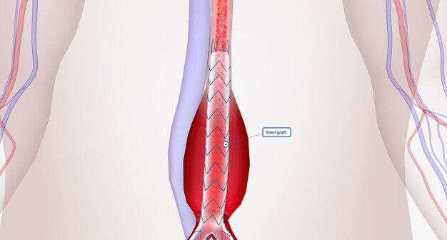 Une endoprothèse est un treillis métallique fin recouvert d'un tissu en forme de tube