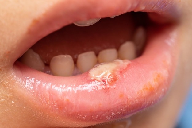 Enfant ayant une lèvre inférieure enflée avec une infection par du pus causant des aphtes
