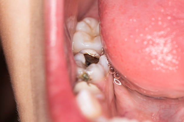 Photo l'enfant ouvre la bouche pour montrer la carie des dents cariées. une jeune fille à un rendez-vous chez le dentiste. dents d'enfants malades.