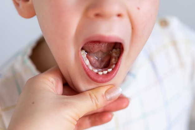 Enfants Dents De Requin Première Dent Qui Apparaît Dans L'enfance Derrière Les Dents De Lait