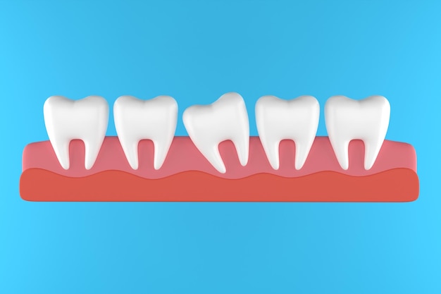 Ensemble de dent avec appareil orthodontique