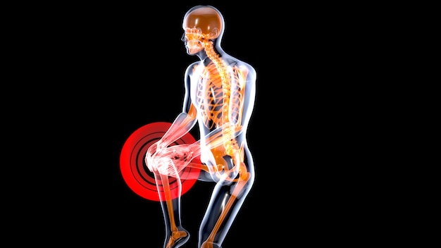 Entorse du genou ou douleur menant à une illustration 3D de la douleur