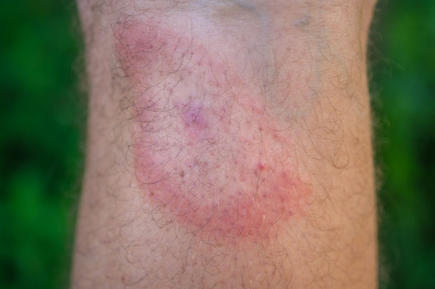 Photo Érythème migrant après une morsure de tique sur la jambe d'un homme. un symptôme de la borréliose transmise par les tiques. un anneau rouge en forme de cible sur la jambe