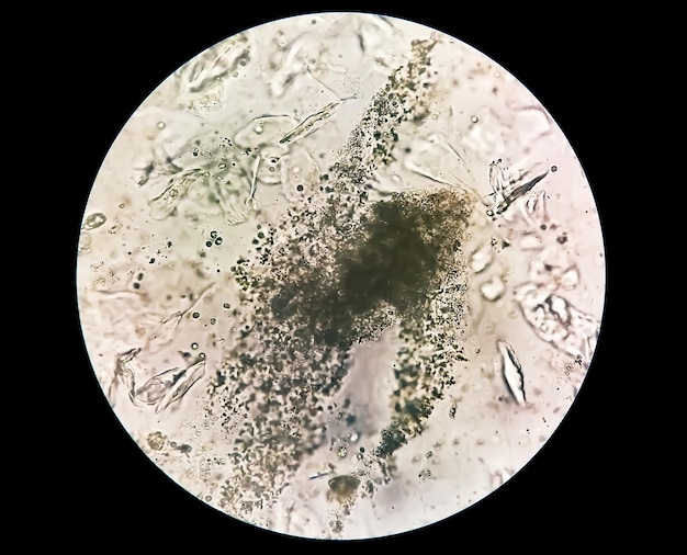 Examen microscopique des urines montrant un plâtre hyalin avec des cellules de pus et des globules rouges