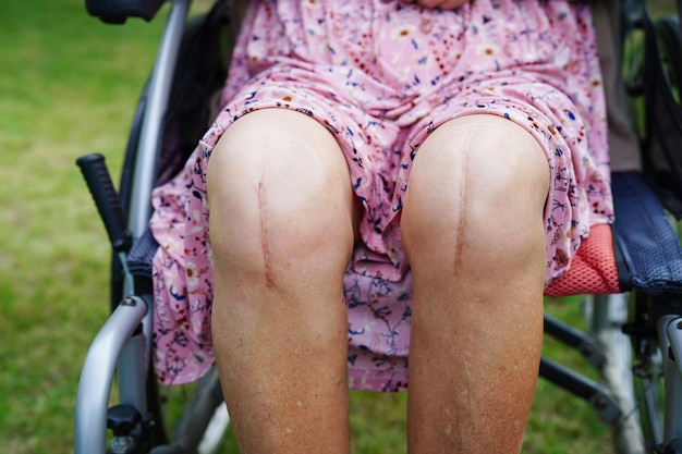 Une femme âgée asiatique patiente avec une arthroplastie du genou cicatricielle à l'hôpital