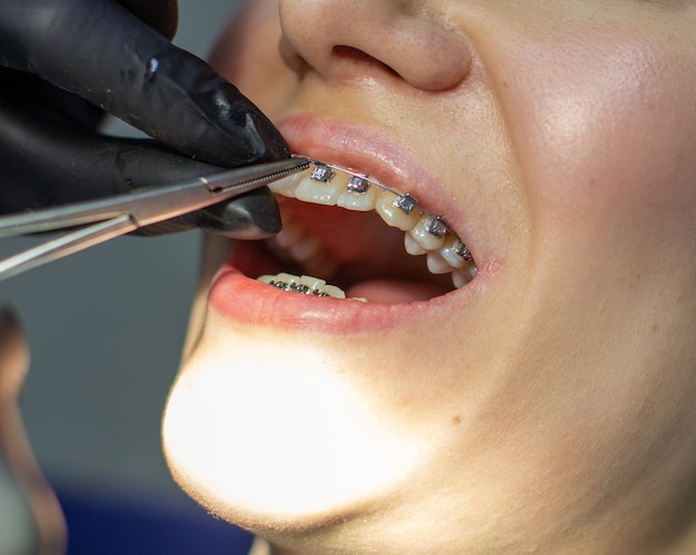 Une femme avec des appareils dentaires rend visite à un orthodontiste à la clinique dans un fauteuil dentaire