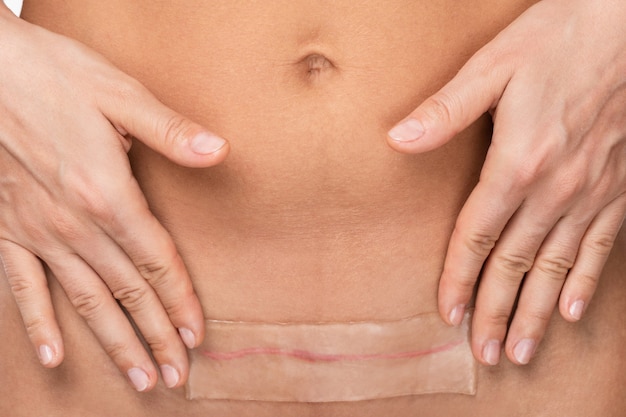 Une femme applique un patch avec une feuille de silicone sur sa cicatrice après une chirurgie par césarienne.