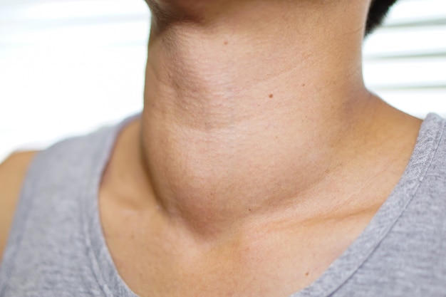 Une femme asiatique a une hypertrophie de la glande thyroïde