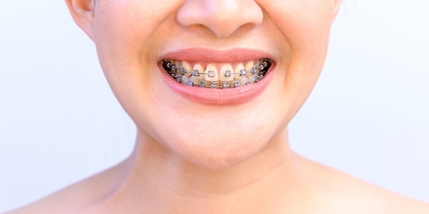 Femme asiatique souriante portant un appareil de rétention orthodontique. Soins dentaires et dents saines.