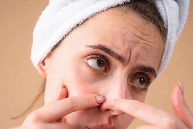 Femme bouchent le visage en serrant les boutons. L'acné tache la peau d'une jeune femme. Spot cicatrice acné, taches de rousseur et traitement du visage de la peau à pigmentation mélasma, concept de peau à problèmes.